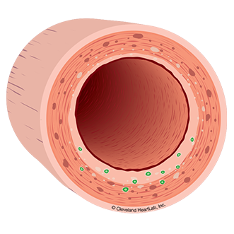 artery wall