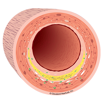 artery wall section 2